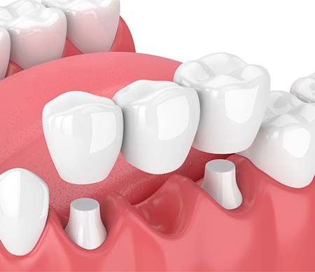 Stock photo for Dental Bridge