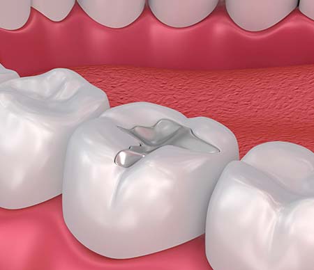 Stock photo for Composite Fillings