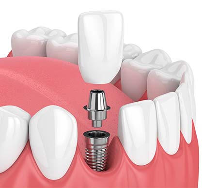 Stock photo for Dental Implants